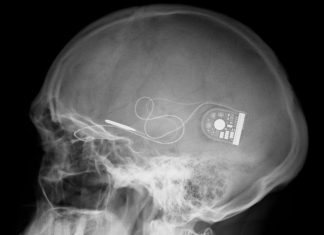 Oamenii de ştiinţă au creat un implant pentru creier care îţi poate creşte capacitatea memoriei cu până la 30%